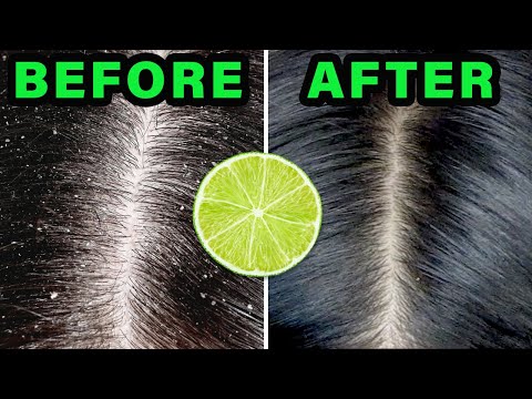 How to REMOVE DANDRUFF in 10 minutes USING LEMON JUICE!