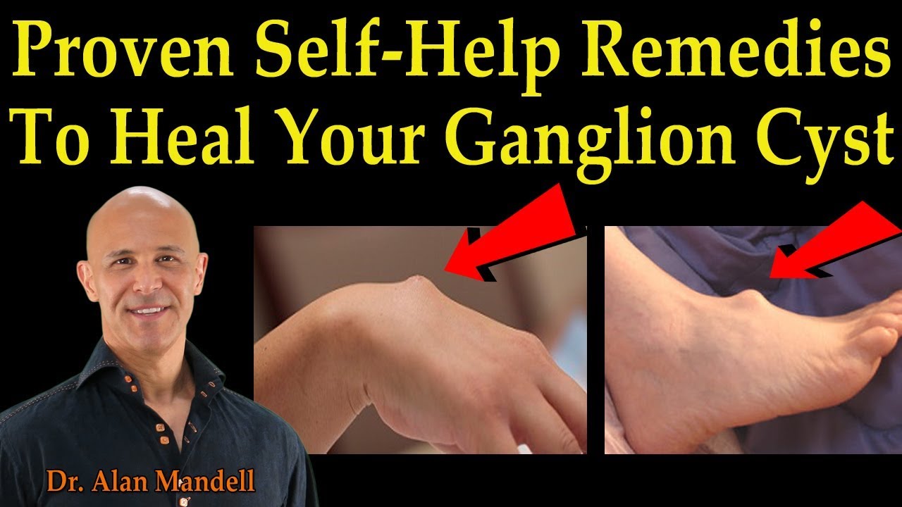 Cure for ganglion cyst