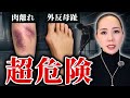 【危険】大人バレエでよくある怪我と対策を徹底解説します！