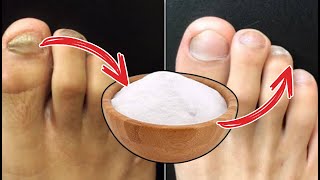 URGENT MIX THIS AND GOODBYE FUNGI ON NAILS Foot Fungus Natural Treatment