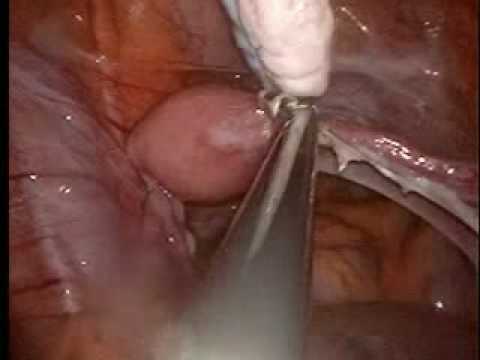 Single Port Surgery  BSO