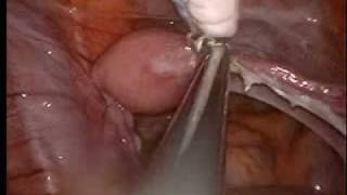 Single Port Surgery  BSO
