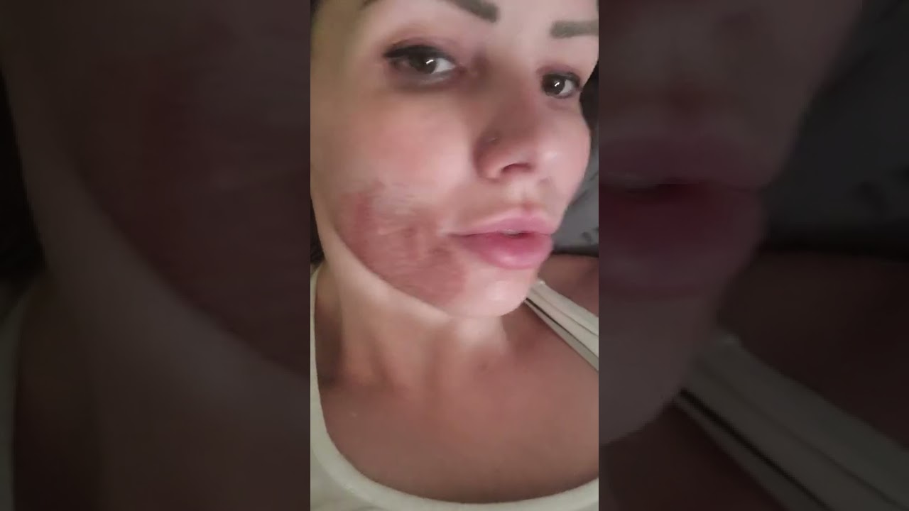 Fibroblast Plasma Pen