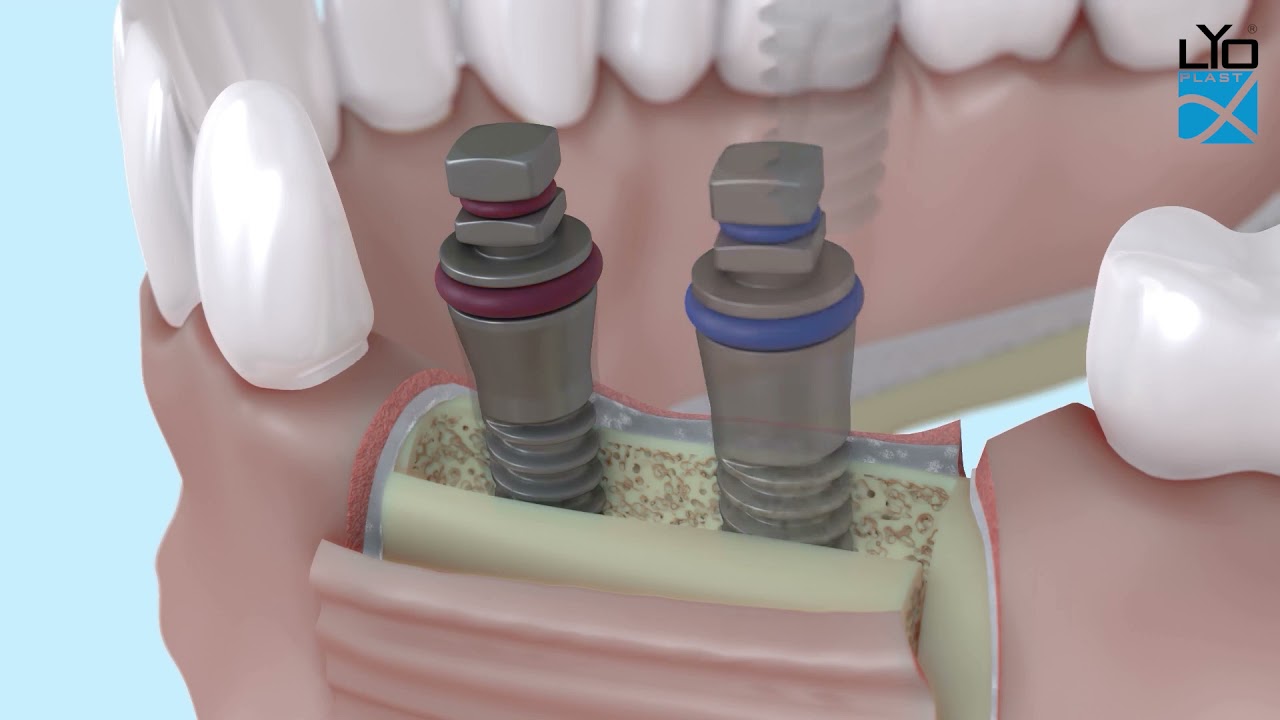 Пластика альвеолярного отростка челюсти по ширине методом расщепления совместно с имплантацией