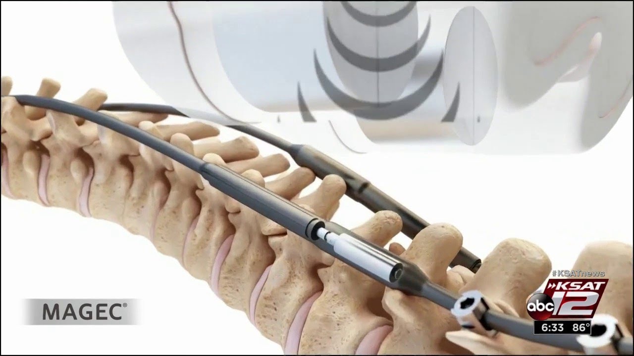 Magic Magnets Help Lengthen Spine For Scoliosis Patients Youtube