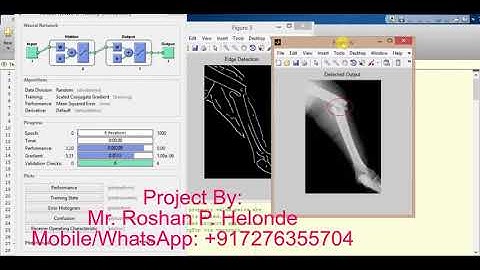 Bone Fracture Detection using neural network matlab project source code
