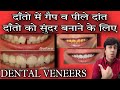 dental Veneers kya hote hai |dental  veneers cost in India