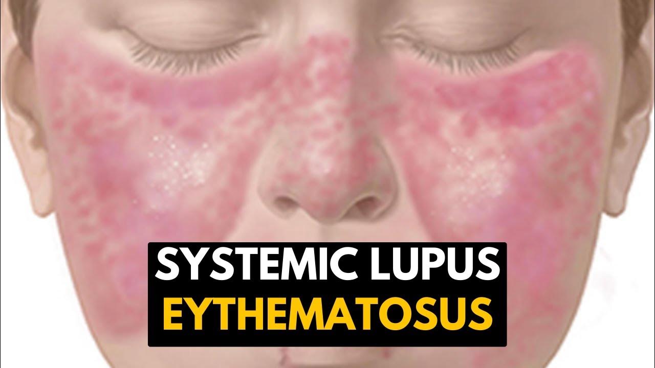 Systemic Lupus Eythematosus (SLE), Causes, Signs and Symptoms