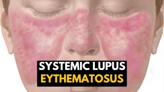 Systemic Lupus Eythematosus (SLE), Causes, Signs and Symptoms, Diagnosis and Treatment.