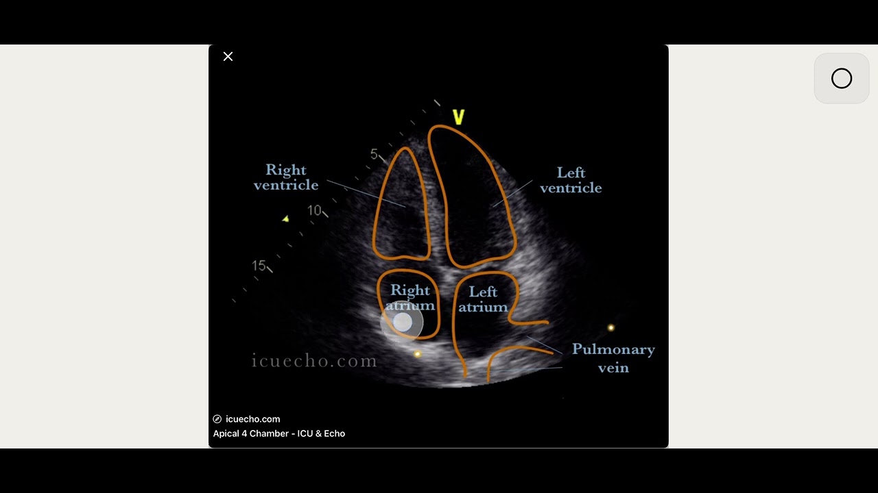 Practical scenarios and echo assessment of right ventricular stain
