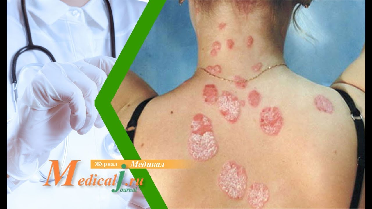 Псориаз: причины, лечение (сдерживание ремиссий) - YouTube
