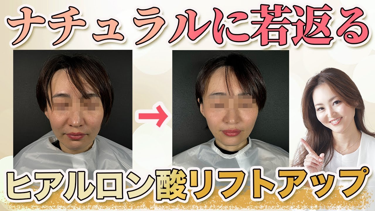 【顔のたるみが、、、】お手軽にできるヒアルロン酸注射でリフトアップについて美容皮膚科医が解説！
