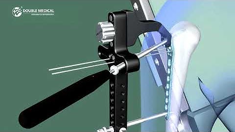 Double Medical Proximal Humeral Locking Plate LISS