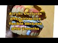 Pustiso Acrylic Dentures and Flexible Dentures