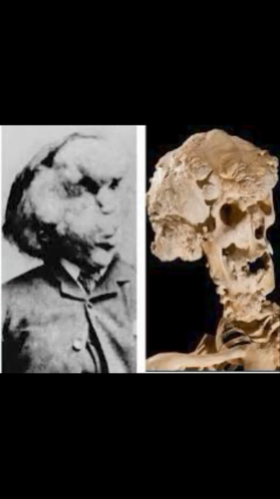 The Living Tree Man: Dede Koswara’s Haunting Story | Human Who Grew Into Wood #sideshow #like #viral