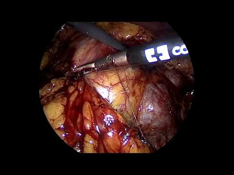 Right Heminephrectomy in horseshoe kidney