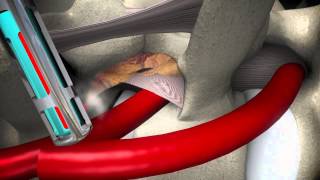 Right sided Transforaminal Endoscopic Lumbar (laser) Decompression and Foraminoplasty Animation 1