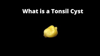 What is a Tonsil Cyst Cyst Of Tonsil