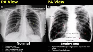 Normal Vs Smoker's Lung Chest X-Ray Findings | Prominent Bronchovascular Markings, COPD, Emphysema