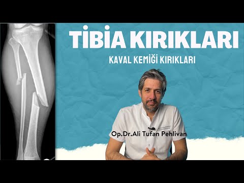 Kaval Kemiği (Tibia ) Kırıkları