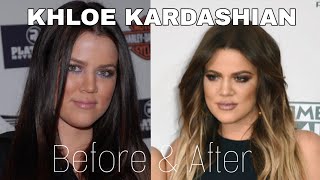 KHLOE KARDASHIAN - BEFORE and AFTER surgery
