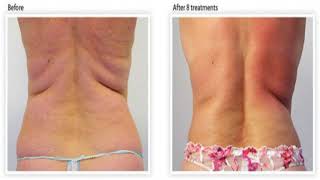 Can Gotu Kola Get Rid Of Cellulite