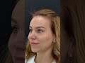 Периорбитальное омоложение. Результат эндоскопической подтяжки тканей лица