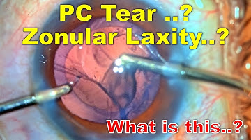 PC Tear / Zonular laxity..? What is this..? - Dr Deepak Megur