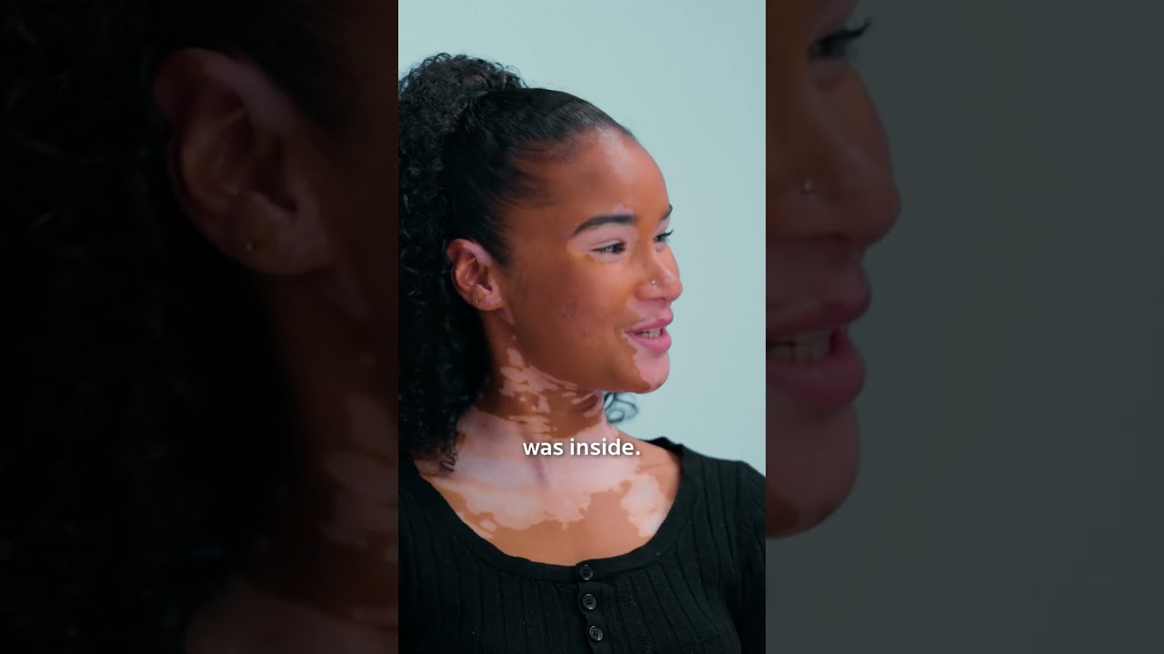 What Causes Vitiligo?