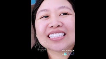 Làm Răng Sứ Để Nụ Cười Tự Tin Toả Sáng Cùng Nha Khoa Ali Bạn Nhé