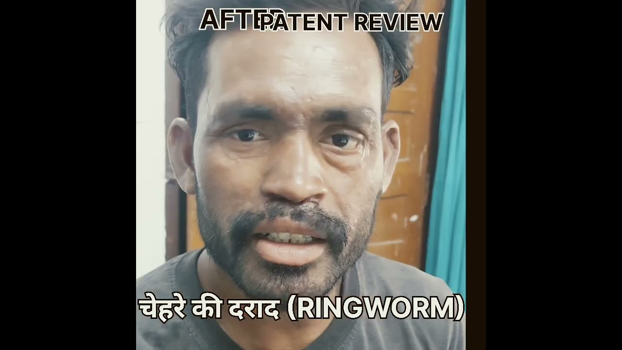 चेहरे की दराद/खुजली  (FACIAL RING WORM) 
