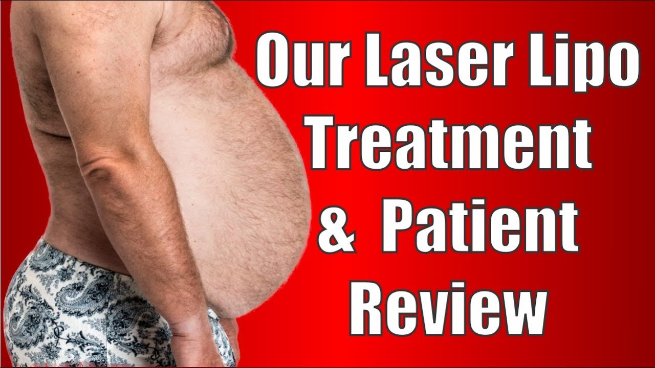 Lipo Laser (ilipo) Treatment & Review From a Patient YouTube