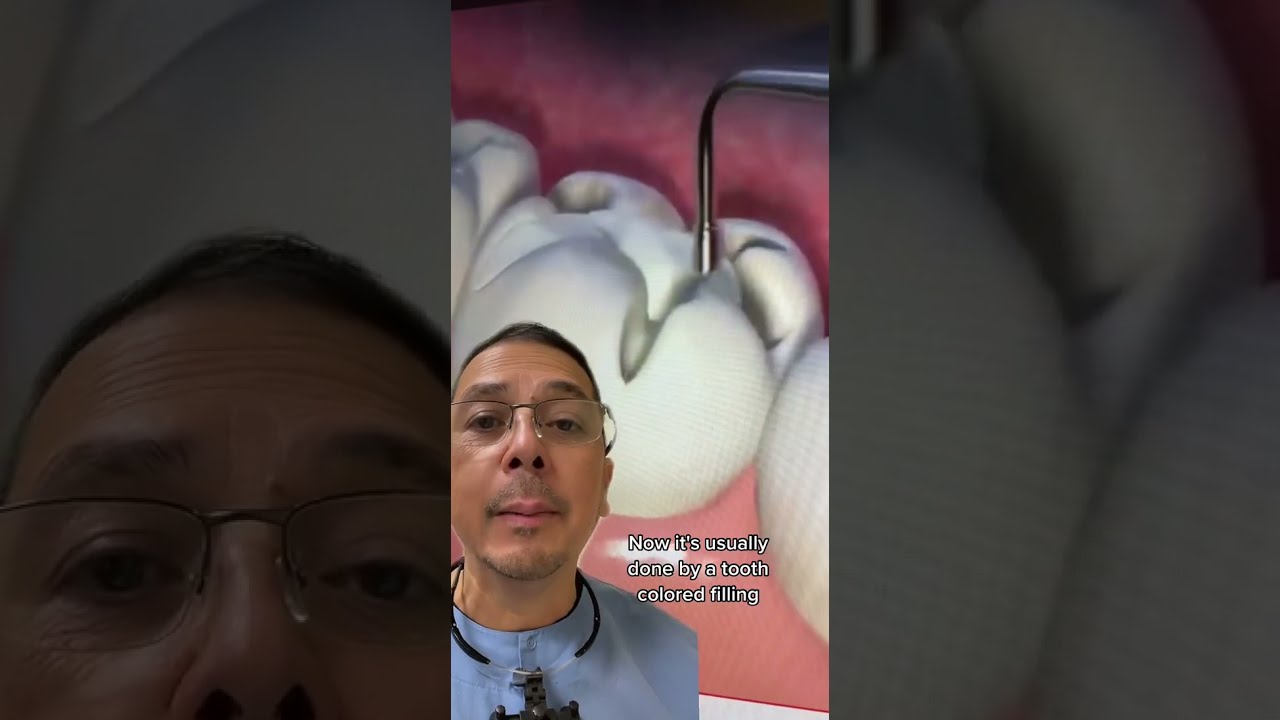 Composite Tooth Filling EXPLAINED In Office To Hands On Dental Training