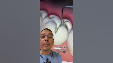 Composite Tooth Filling EXPLAINED |  In Office to Hands On Dental Training