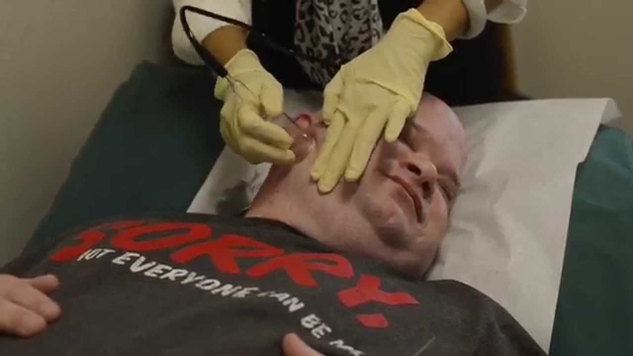 Acupuncture and Cupping for Chronic Migraine YouTube