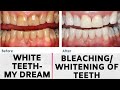 Best Way To Whiten Your Yellow Teeth| Professional Bleaching/Whitening Of Teeth