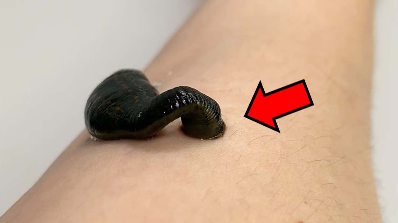 거머리에게 물린 부위에는 특이한 무늬가 나타납니다 ㄷㄷ