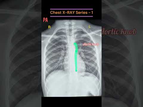 Chest Xray Basic