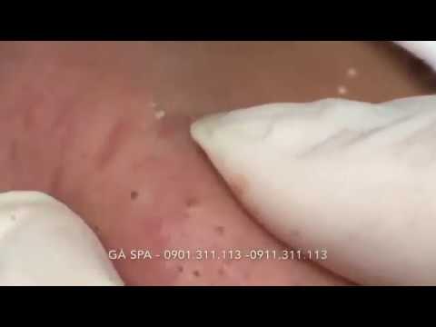 Big Fat Blackheads for your Viewing Pleasure.