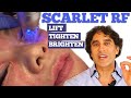 SCARLET RF - Non Surgical Face Treatment