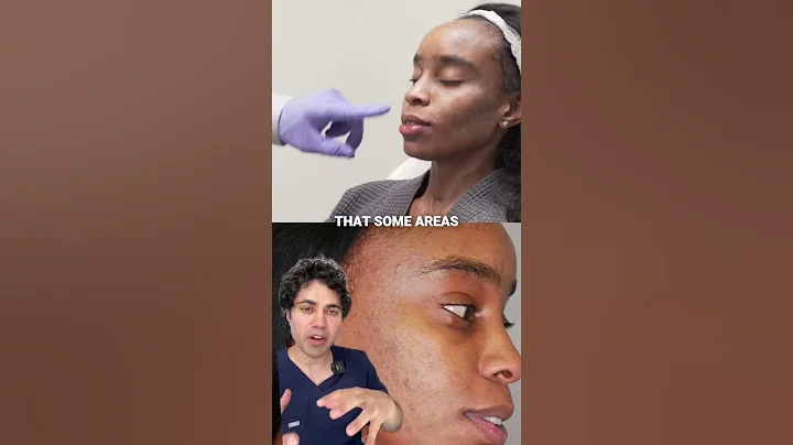 The Power of PicoSure #lasertreatment #skinresurfacing