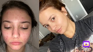 Affordable Skincare Routine / Pregnancy &amp; Acne Prone