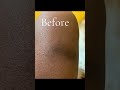 How to Fade a 20 + Year Old Scar- FAST. Hyperpigmentation, Stretch Marks Etc Don't Stand a Chance