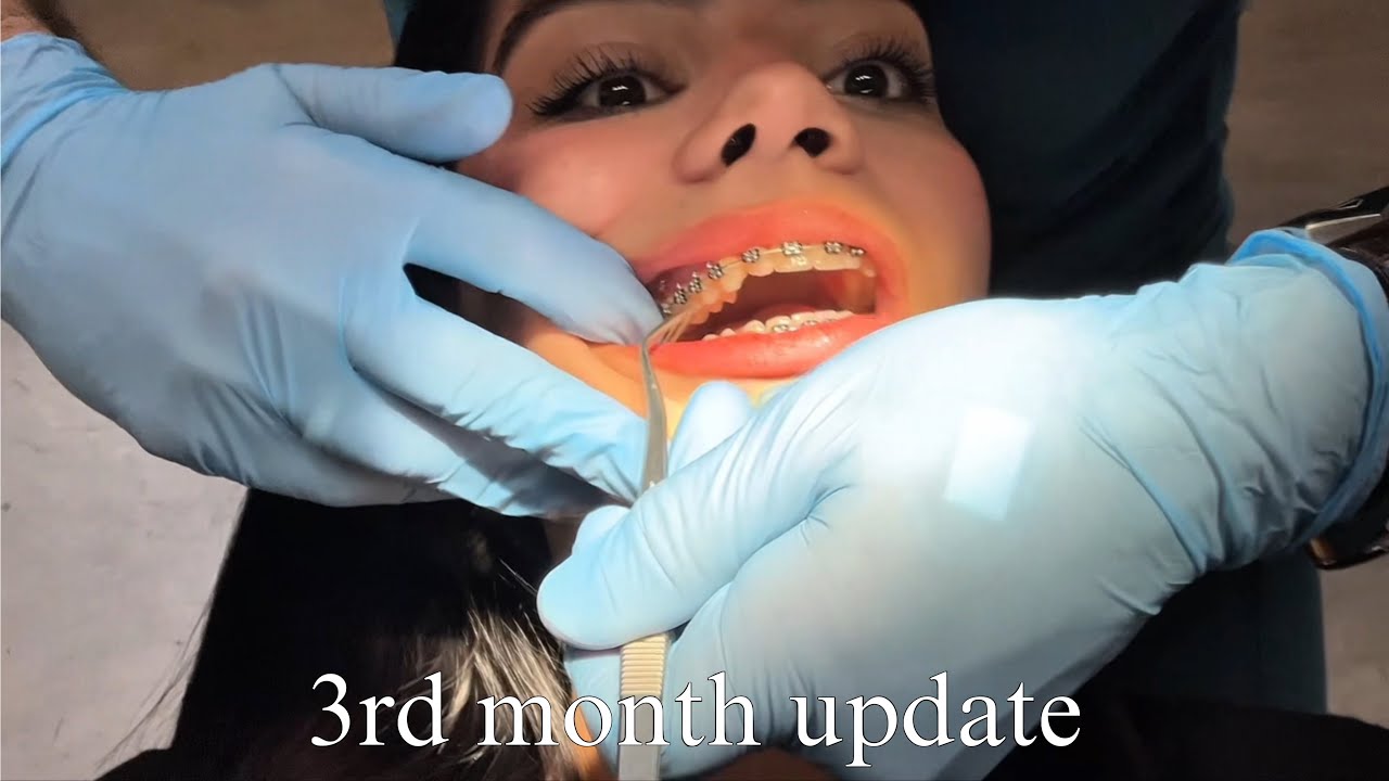 Braces update month 3 🦷 