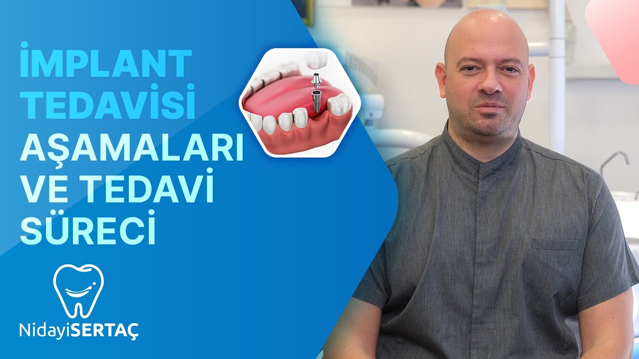 İmplant Tedavisi Aşamaları ve Tedavi Süreci
