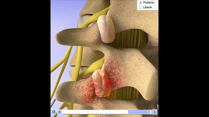 Facet Joint Syndrome