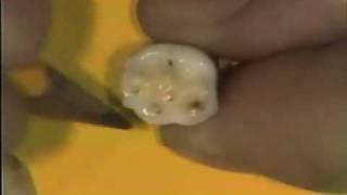 Dental Anatomy: Mandibular Molars Review
