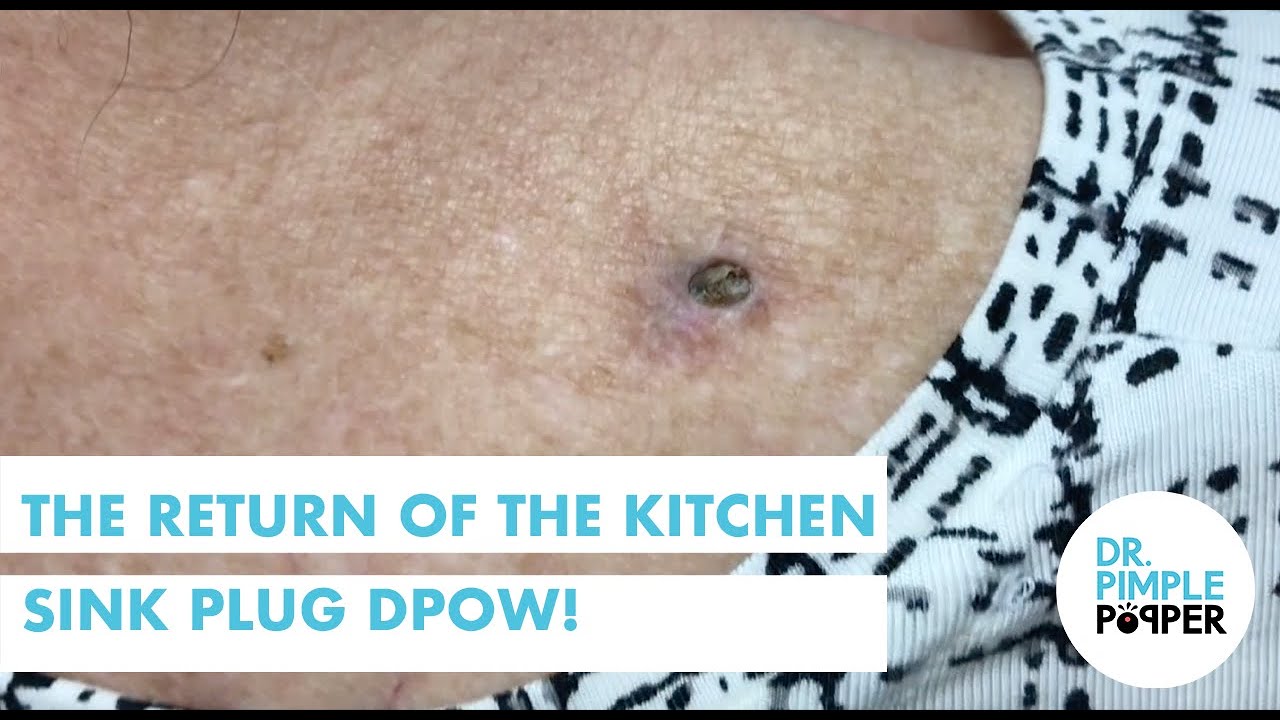 The Return Of The Kitchen Sink Plug Dilated Pore Of Winer Youtube