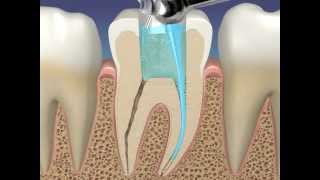 EndoVac from SybronEndo