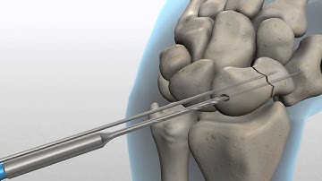 Acutrak 2.0 screw for a Scaphoid Hand Fracture